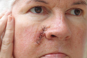 An older woman has a surgical scar on her face after the surgery performed by a mohs surgeon.