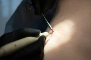 dermatologist performing mohs surgery