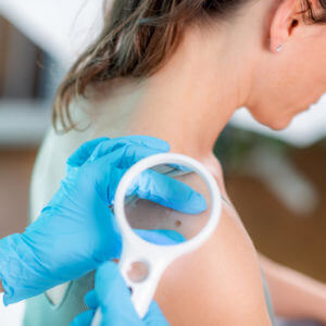 Detecting Skin Moles Under Magnifying Lamp During Skin Cancer Screening for Cancer Prevention and Early Intervention.