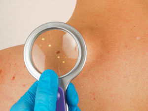 Skin examination by a dermatologist to check for melanoma skin cancer.