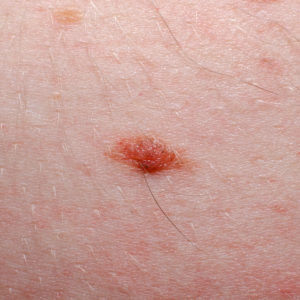 Close-up view of a skin lesion, possibly a basal cell carcinoma.