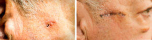 Basal Cell Carcinoma on the face of older man before and after surgery.