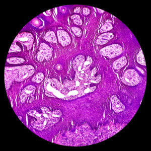 Non healing ulcer on scalp, microscopic image show skin, features of basal cell carcinoma.