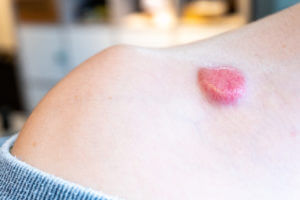 Raised dermatfibrosarcoma protuberans (DFSP, non-melanoma skin cancer) on chest shoulder having formed red pigment and spider veins