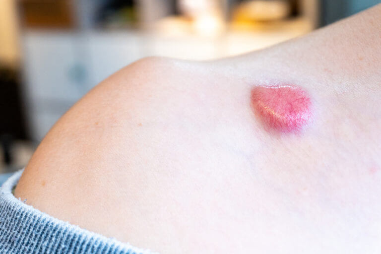 Raised dermatfibrosarcoma protuberans (DFSP, non-melanoma skin cancer) on chest shoulder having formed red pigment and spider veins